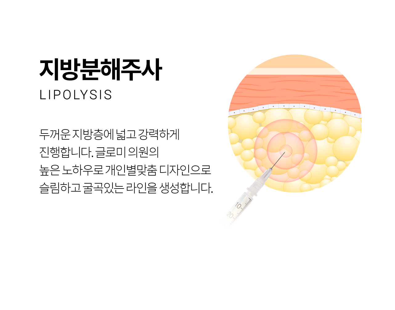 +SLIM 근육 보톡스 톡톡 줄어드는 근육 - 사각턱/바디의 근육에 주사하여 두께와 부피를 줄여 슬림한 라인을 만듭니다.